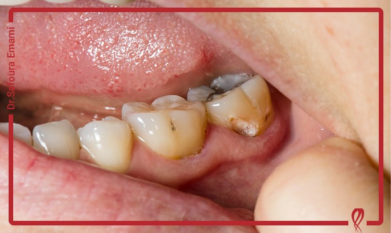 آیا پوسیدگی دندان با دارو درمان می‌شود؟ واقعیت یا تبلیغ؟